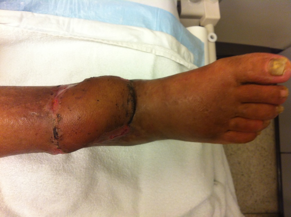 Distal Tibia Skin Graft